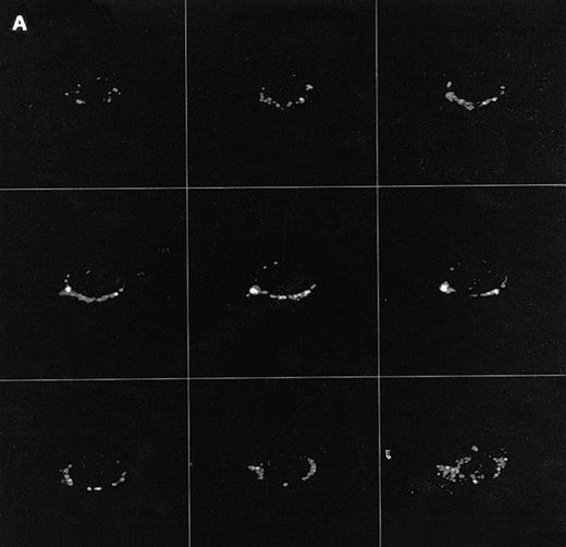 Fig. 1. Confocal analysis of PLCγ1 expression at the external leaflet of the plasma membrane in human T lymphocytes. (A) Unstimulated cell (increments of 0.85 μm in z-axis; cell size, 8 μm); (B) PHA-stimulated cell (increments of 0.9 μm in z-axis; cell size, 17 μm); (C) PHA-stimulated cell incubated for 90 minutes with interferon beta (increments of 0.75 μm in z-axis; cell size, 14 μm). (D) PHA-stimulated cell incubated for 24 hours with interferon beta (increments of 0.54 μm in z-axis; cell size, 10 μm); (E) cell labeled with anti-Leu-5b MoAb (CD 2), used as an internal control (increments of 0.56 μm in z-axis; cell size, 11 μm). Note that the membrane labeling evident in resting lymphocytes became weaker in PHA-stimulated cells, and again was strongly detectable after addition of interferon. As internal controls, cells were incubated with anti-Leu-5b MoAb, a T-lymphocyte surface marker, which strongly labeled the membranes (Fig 2E), while the reactions performed in the absence of the primary antibody yielded consistently negative results. Results obtained by incubating lymphocytes with anti-STAT 91/84 protein as an intracellular marker (to check membrane integrity) and with anti-PLC β and δ isoforms did not disclose any FITC membrane labeling.