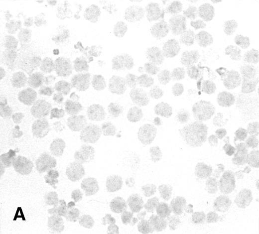Fig. 1. Immunostaining for IL-2 in transduced but nonselected NK-92 cells. (A) P-NK-92 cells incubated for 48 hours in the absence of exogenous IL-2 prior to staining. (B) Transduced nonselected (48 hours posttransduction) IL-2/Neo/NK-92 cells incubated for 48 hours in the absence of exogenous IL-2 prior to staining. Insert shows an IL-2–expressing NK cell (original magnification ×1,000). The staining reaction was developed with AEC, and the cells were counterstained with hematoxylin. For A and B, original magnification is ×500.