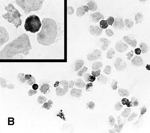 Fig. 1. Immunostaining for IL-2 in transduced but nonselected NK-92 cells. (A) P-NK-92 cells incubated for 48 hours in the absence of exogenous IL-2 prior to staining. (B) Transduced nonselected (48 hours posttransduction) IL-2/Neo/NK-92 cells incubated for 48 hours in the absence of exogenous IL-2 prior to staining. Insert shows an IL-2–expressing NK cell (original magnification ×1,000). The staining reaction was developed with AEC, and the cells were counterstained with hematoxylin. For A and B, original magnification is ×500.