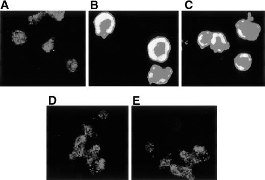 Fig. 7. Confocal microscopical analysis of polymerized F-actin on ATL cells. Resting normal T cells (A), ATL cells obtained from 2 representative ATL patients (B and C), and ATL cells pretreated with 1 μg/mL pertussis toxin (D) or 100 nmol/L wortmannin (E) for 2 hours at 37°C were incubated on fibronectin-coated slides for 1 minute, and the F-actin in these cells was stained with rhodamine-phalloidin and was observed by confocal microscopy (original magnification ×1,000).