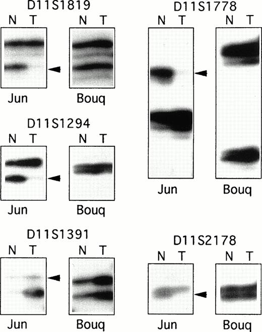 Fig. 1. PCR analysis of LOH. Examples of the PCR analysis of LOH for two T-PLL cases: “Jun”, which showed a large region of LOH for the 11q22-23 informative markers, and “Bouq,” which showed balanced heterozygosity of the markers. Each autoradiograph includes PCR products from normal (N) and tumor (T) DNAs. Arrowheads indicate allelic loss in tumor DNAs.