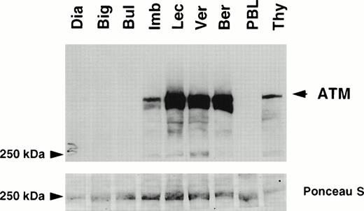 Fig. 2. Expression of ATM in T-PLLs . Detergent lysates (60 μg/lane) were subjected to SDS-polyacrylamide gel electrophoresis (SDS-PAGE) through a 5% gel. Immunoblot analysis was performed using the anti-ATM antiserum pAB 132 (upper panel). Ponceau S staining was used to verify equal loading and protein integrity (lower panel). Samples analyzed were T-PLLs with LOH of the 11q22-23 region: Dia, Big, Bul, Imb, and Lec; T-PLLs without LOH: Ver and Ber; normal peripheral lymphocytes (PBL); normal thymocytes (Thy). Molecular weight standards are given in kD. The ATM specific signal is arrowed.