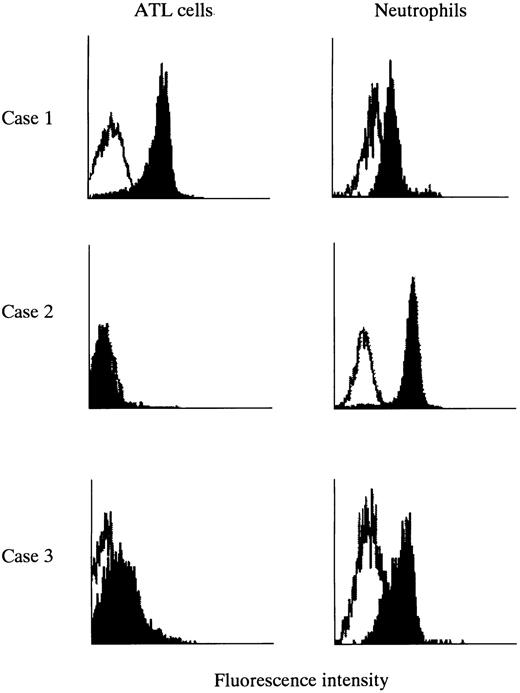 Fig. 1. Expression of Fas antigens on ATL cells and neutrophils from patients with ATL. Heparinized blood was incubated with monoclonal antibody ZB4 (against Fas antigen) or control mouse IgG. Expression of Fas antigen on ATL cells and neutrophils was examined simultaneously by flow cytometry. Shadowed peaks represent Fas antigen and open peaks represent control mouse Ig. Case no. 1, Fas-positive ATL cells; case no. 2, Fas-negative ATL cells; case no. 3, ATL cells with decreased expression of Fas antigen.