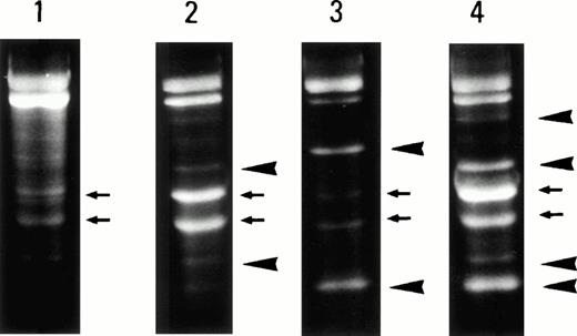 Fig. 4. RNase protection assay of Fas gene transcripts. The reaction mixtures were digested with ribonuclease and electrophoresed in a 2.5% agarose gel. In normal PBMCs, the intact and spliced Fas gene transcripts (small arrowheads) were detected (lane 1). In cases no. 4 and 5 (lanes 2 and 3, respectively), additional bands (big arrowheads) could be found. In the Fas-negative ATL case, multiple bands were identified (lane 4, case no. 2), two of which corresponded to bands in case no. 4.