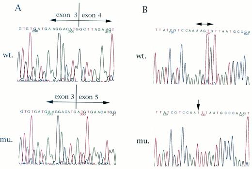 Fig. 3. Sequences of Fas gene cDNA clones derived from Fas-negative ATL cells. Sequences of Fas gene cDNA from Fas-negative ATL cells were determined as described in the Materials and Methods. In the clones sequenced, four clones lacked exon 4 (A). The other five clones showed a 5-bp deletion and a 1-bp insertion in exon 2 (B). Both mutations caused premature termination of Fas gene translation.