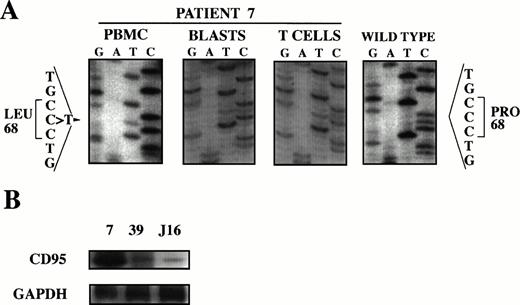 Fig. 2. Mutation analysis of patient 7. (A) Heterozygous germline mutation in exon 3 of CD95 causing a 68Pro → 68Leu change. Genomic DNA of PBMC was subjected to PCR using primers flanking exon 3 of CD95, amplificates were subjected to SSCP analysis, abnormal migrating bands were cut-out from the gel, reamplified, and sequenced. T-ALL blasts and mature T lymphocytes were immunomagnetically purified, exon 3 of CD95 amplified by PCR and sequenced. Nucleotide sequence is compared to wild type. Protein is numbered in respect to the start of the mature protein (according to Itoh et al46). (B) CD95 mRNA is strongly expressed compared with cryopreserved blasts from a different patient and thawed Jurkat cells. mRNA was determined by RT-PCR and compared with GAPDH.
