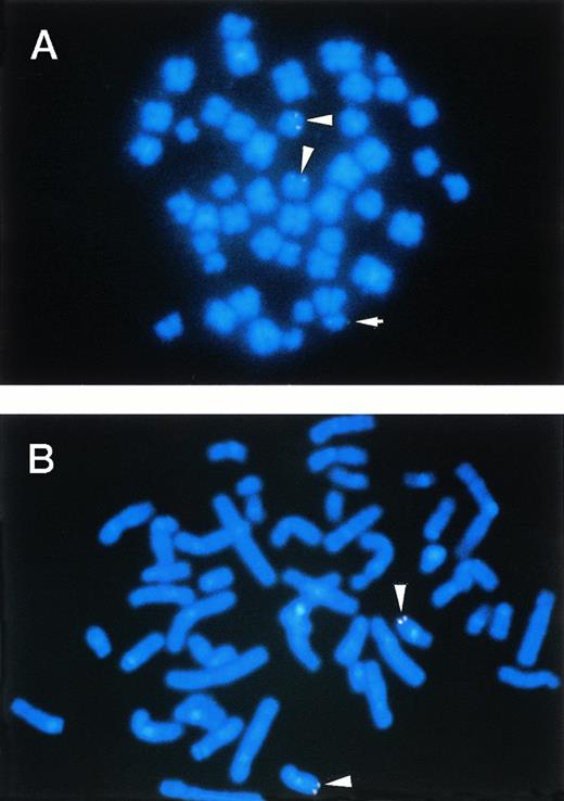 Fig. 7. FISH. (A) and (B) illustrate the mapping of the P1 clone P122F9 in cells from the patient no. 3 and in cells from a normal individual, respectively. The P122F9 probe hybridized to both of the der(16) and the der(21) chromosomes, as well as to normal chromosome 16 in patient no. 3. The normal 16 and the der(16) chromosomes are indicated by an arrowhead, and the der(21) chromosome is indicated by an arrow.