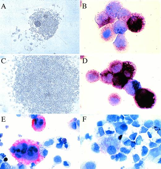 Fig. 2. In situ appearance and the constituent cells of SCF + GM-CSF–dependent or SCF + GM-CSF + TPO–dependent colonies. (A) and (C) show the colonies with the maximal size grown by stimulation with SCF + GM-CSF or with SCF + GM-CSF + TPO from JCML CD34+CD38high cells, respectively. (B) and (D) show the staining of the constituent cells of 20 pooled colonies grown by SCF + GM-CSF or with SCF + GM-CSF + TPO from JCML CD34+CD38high cells with both ANB (brown) and NASDCA (blue), respectively. (E) and (F) show the staining of the constituent cells of 20 pooled colonies grown by SCF + GM-CSF + TPO from normal or JCML BM CD34+CD38high cells with an MoAb for CD41b using the LSAB Kit, respectively.