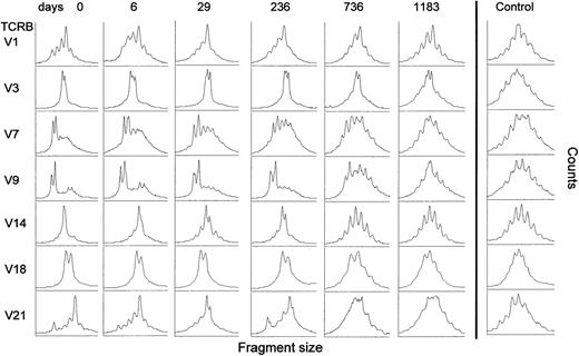 Fig. 1. Junctional region size distribution patterns of RT-PCR products from various TCRBV subfamilies from patient A. Various time points are shown. The first blood sample was taken at the start of IFN-α (day 0). To compare different samples in time, Phosphor Imager scans obtained from the radioactive labeled products on dPAGE gels are shown. The right part of the figure shows the pattern of a healthy individual.