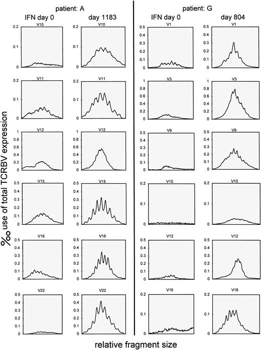 Fig. 2. Follow-up of junctional region size distribution patterns of RT-PCR products from TCRBV families in patients A and G showing very weak signals at initiation of IFN-α therapy. In a semi-quantitative method the recovery of polyclonal T cells within a particular TCRBV gene family is shown. The y-axis represents the relative use of total expression calculated by adding the counts obtained from each single pixel within the graph.