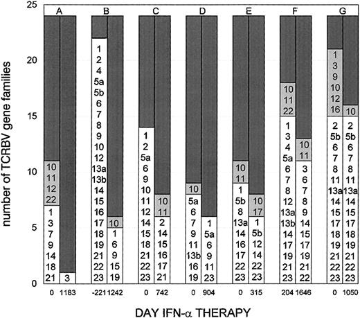 Fig. 3. Distribution of 22 well-established TCRBV gene families from seven HCL patients, analyzed before and during IFN-α therapy. The X-axis shows the time points in days. Patient B was analyzed 221 days before IFN was started. The Y-axis gives the absolute number of TCRBV families assessed from 1-23 with TCRBV20 not analyzed, and with TCRBV5 and TCRBV13 shown as 5a, 5b, 13a, and 13b. The large BV5 was split into 5a (BV5S1) and 5b (BV5S2-6); amplification of BV13 resulted in two patterns on the gels, which were analyzed separately. PCR pattern: (▪), Polyclonal; (▧), absent/weak; (□), oligoclonal.