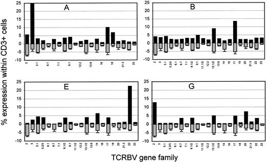 Fig. 4. TCRBV repertoire of four HCL patients during active disease. The results are expressed as percentage of CD3+cells. For specific MoAbs see Materials and Methods. The results obtained for BV2, BV3, and BV17 were confirmed by other MoAbs detecting the same TCRBV phenotype. For comparison, the TCRBV repertoire obtained from five healthy donors is given as mean ± SD for each BV family (gray bars, lower part of each subfigure).