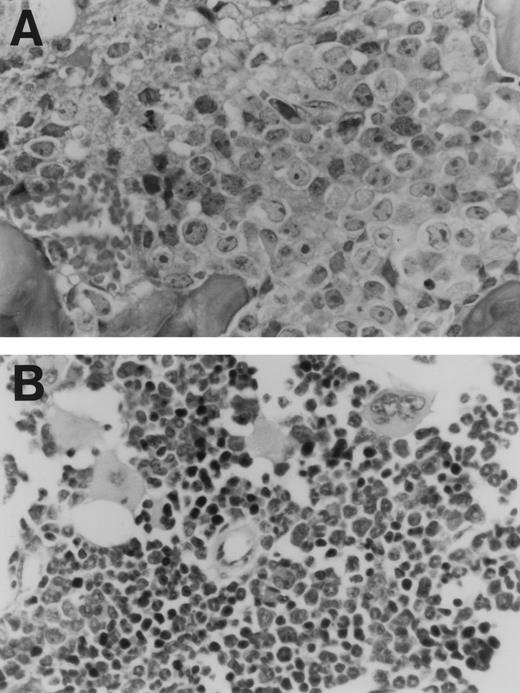 Fig. 6. Histologic evidence of disseminated lymphoma in a nude mouse injected with a CD44ex10 Namalwa transfectant. This representative animal received a tail vein injection of CD44ex10 Namalwa cells and subsequently developed hindlimb paralysis. Thereafter, the animal was sacrificed and evaluated for additional histologic evidence of disseminated lymphoma. The bone marrow (A) is almost completely replaced with aggressive NHL. (B) The bone marrow of a control animal is included for comparison.