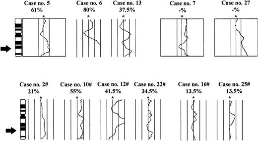 Fig. 2. Average ratio profiles of chromosomes 11 in cases with overrepresentations of sequences. The percentages below the case numbers indicate the size of the subclone with gain of 11q as determined by interphase cytogenetics. The arrow indicates the chromosomal map position of YAC clone 755b11, which was used for interphase analysis. For cases 2, 6, 10, 12, 13, and 22, images were acquired and evaluated using the Cytovision software package (Applied Imaging). Cases 5, 7, and 27 were evaluated using the ISIS software package (MetaSystems). The ratios of FITC to rhodamine fluorescence are plotted along the chromosomes. The central line (asterisks) indicates a ratio value of 1.0; the lines to the right indicate ratio values of 1.25 (all cases) and 1.5 (all cases except nos. 5 and 7), respectively; and the lines on the left indicate values of 0.75 (all cases) and 0.5 (all cases except nos. 5, 7, and 27), respectively. In case nos. 7 and 27, adequate material was limited and therefore only CGH analysis was performed. #In these cases, the diagnostic thresholds were not reached. However, there is a clear shift of the ratio profiles toward overrepresentation. In these cases, gains of 11q were diagnosed by FISH analysis. For cases 16 and 25, in which gains were diagnosed only in minor subclones, no shifts of the ratio profiles were observed.