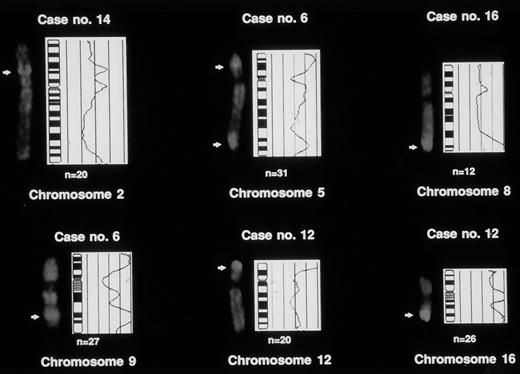 Fig. 3. Partial CGH karyotypes of cases with high-level DNA amplifications. Images were acquired and evaluated using the CYTOVISION software package (Applied Imaging). Numbers at the bottom indicate the respective chromosomes. Hybridization with the tumor DNA is shown as gray level images. The band-like hybridization signals (arrows) indicate highly amplified chromosomal sequences. On the right side of the ideograms, the average ratios of FITC/rhodamine fluorescence are plotted (“ratio profiles”). The central line indicates a ratio value of 1.0; lines to the right indicate ratio values of 1.25 and 1.5, respectively; and lines to the left indicate ratio values of 0.75 and 0.5. n = number of chromosomes analyzed for calculating the respective average ratio profile.