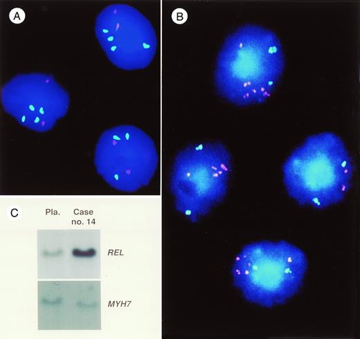 Fig. 4. (A) Photomicrograph of a dual-color hybridization obtained with YAC clone 755b11 mapping to 11q22.3-11q23.1 (detected via FITC, green) and YAC clone 866e7 mapping to 3q26 (detected via rhodamine, red) to cells of patient no. 6. In three cells, three or four green hybridization signals are seen indicating an overrepresentation of sequences on band 11q22.3-11q23.1 in these cells. In contrast, only two red hybridization signals are present indicating a normal copy number of sequences on band 3q26. (B) Photomicrograph of a dual-color FISH experiment with cosmid probe cos-myc 72, containing sequences of the MYC proto-oncogene detected via rhodamine (red) and the YAC clone 963d6 mapping to band 6q21 detected via FITC (green). In this case (no. 16), CGH analysis showed a strong bandlike hybridization signal at chromosomal band 8q23-24.3. In three of the cells a tight cluster of red hybridization signals is visible indicating an amplification of these sequences. In contrast, two green signals are seen in all cells. (C) Southern blot analysis of DNA of case no. 14 (right) and DNA from a placenta (left) serving as an internal control. Probes for the REL proto-oncogene andMYH7 (control) are marked on the right side. Note the high intensity of the REL signal in this case. Densitometric evaluation showed a sevenfold amplification of this gene.