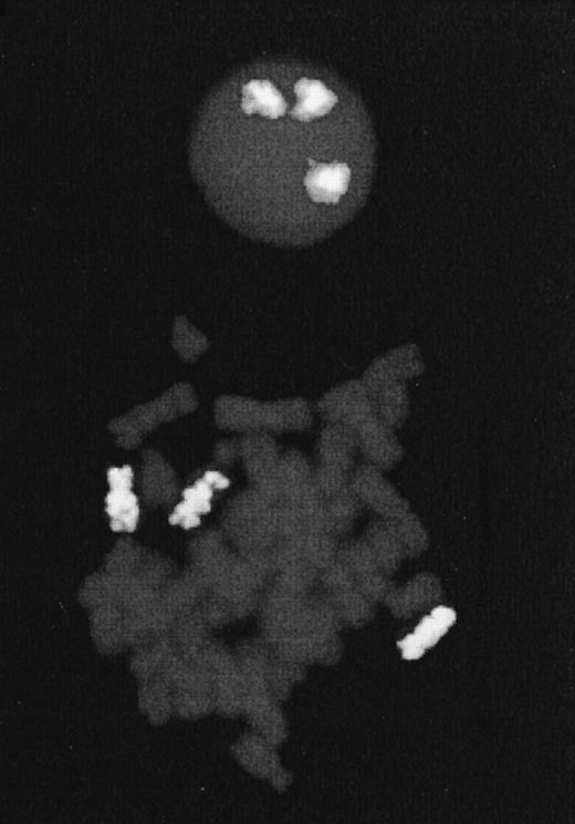 Fig. 3. FISH performed on Cou-LS cells with whole chromosome paint for chromosome 7. To the top a nucleus with three chromosomal domains; to the bottom a mitosis with three labeled chromosomes 7.