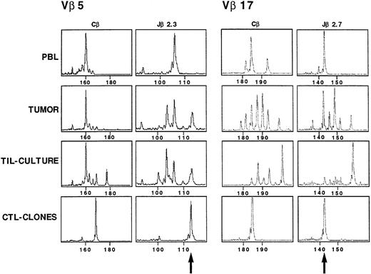 Fig. 10. CDR3 size profiles of TCR Vβ5 and TCR Vβ 17 transcripts in samples from patient Cou analyzed with fluorescent Cβ, Jβ2.3, and Jβ2.7. cDNA made from total RNA extracted from TC5 (Vβ5) and TC7 (Vβ17) CTL clones, TIL-culture, tumor suspensions, and PBL from the patient were amplified in a PCR reaction primed by Vβ5/Vβ17– and Cβ–specific primers. The unlabeled amplification products were elongated with nested fluorescent Cβ, Jβ2.3, and Jβ2.7. Aliquots were subjected to electrophoresis and analysis on an automated sequencer. Arrows indicate the signal corresponding to the two CTL clones TCR transcripts.