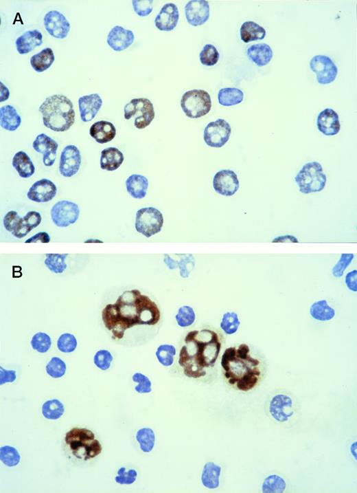 Fig. 1. Immunoperoxidase staining for p53 protein: the positive population shows intense brown nuclear staining. (A) Cytospin of CLL lymphocytes: the immunostaining shows the coexistence of p53-positive and p53-negative cells within the same leukemic population. (B) Cytospin containing a mixture of Raji cells (p53 positive) and normal peripheral blood lymphocytes (p53 negative) used as control.