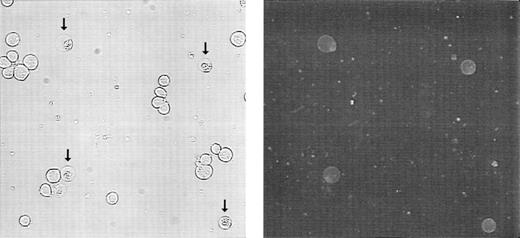 Fig. 4. Externalization of phosphatidylserine on 24 hours treatment of Molt-4 cells with GW1843. Cells were collected, washed, treated with FITC-Annexin-V, and viewed by phase contrast (left) or fluorescein fluorescence (right) microscopy. Arrows indicate blebbed cells. These photomicrographs are from a representative experiment from four separate determinations.