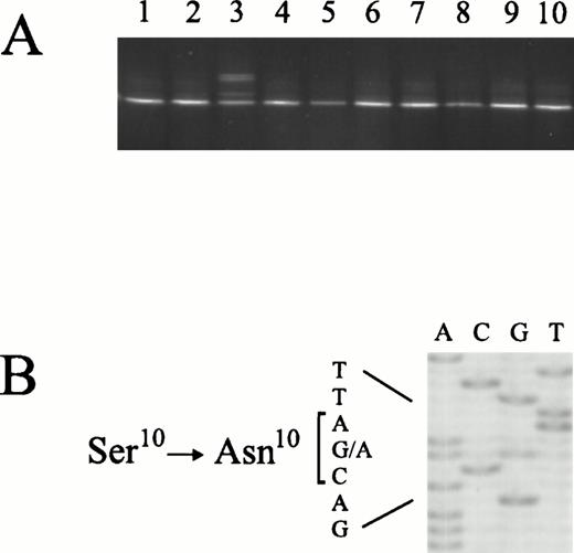 Fig. 1. Detection and identification of MMAC1/PTENmutations in primary lymphomas. (A) PCR/DGGE analysis ofMMAC1/PTEN exon 1 in 10 tumor samples. (B) Direct sequence analysis of the sample displaying an aberrant band pattern in (A). The partial sequence ladder shows a G → A transition, resulting in the substitution of Ser10 with Asn10.