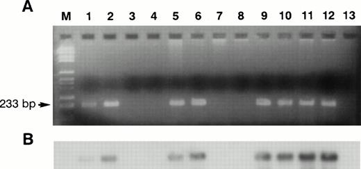Fig. 1. Representative PCR results (45 cycles) on bone marrow biopsies DNA from patients with WM (lanes 1 through 6) or MM (lanes 7 through 12) and negative control (lane 13). (A) Agarose gel stained with ethidium bromide. (B)Hybridization with a 32P end-labeled 25-bp internal oligonucleotide probe.