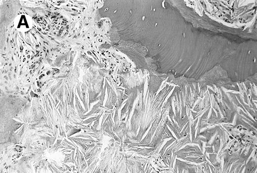 Fig. 1. Photomicrograph of the bone marrow biopsy. (A) Oxalate crystal deposition seen adjacent to hematopoietic cells. (B) Same biopsy section viewed under polarized light showing the birefringent property of oxalate crystals.