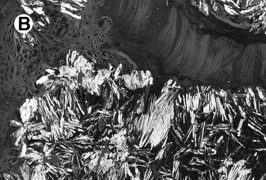 Fig. 1. Photomicrograph of the bone marrow biopsy. (A) Oxalate crystal deposition seen adjacent to hematopoietic cells. (B) Same biopsy section viewed under polarized light showing the birefringent property of oxalate crystals.