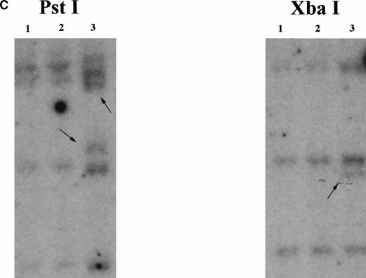 Fig. 2. Identification of the chromosome 7 fusion partner. (A) Schematic diagram of anchored PCR.619 (B) Sequence of theHIP1/PDGFβR breakpoint and schematic of the fusion protein. (C) Southern blot analysis of HIP1 gene locus in control DNA (lanes 1 and 2) and patient DNA (lane 3). Arrows indicate rearranged fragments in the Pst I and Xba I digests.