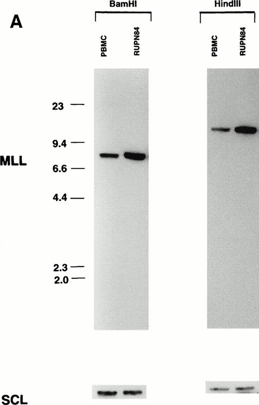 Fig. 2. Southern blot analysis demonstrating multiple copies of the MLL gene in t-AML of patient RUPN 84 and cell line 2L1.BamHI- and HindIII-digested DNAs were hybridized separately with MLL bcr cDNA and SCL genomic probes (A). Although the patient received DNA topoisomerase II-targeted chemotherapy and had monoblastic leukemia, the MLL gene was not rearranged. HindIII-digested DNAs were hybridized simultaneously with MLL bcr cDNA and SCL genomic probes to assess equivalence in loading (B). The bold arrow in (B) indicatesMLL signals; the thin arrow indicates SCL signals. The increased MLL signal intensity compared with PBMC control, 4.3:1 when normalized for loading by hybridization with SCLprobe, is consistent with approximately 8 to 9 copies of theMLL gene in the t-AML and cell line 2L1.