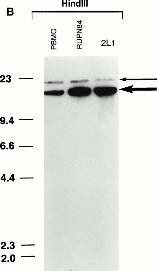 Fig. 2. Southern blot analysis demonstrating multiple copies of the MLL gene in t-AML of patient RUPN 84 and cell line 2L1.BamHI- and HindIII-digested DNAs were hybridized separately with MLL bcr cDNA and SCL genomic probes (A). Although the patient received DNA topoisomerase II-targeted chemotherapy and had monoblastic leukemia, the MLL gene was not rearranged. HindIII-digested DNAs were hybridized simultaneously with MLL bcr cDNA and SCL genomic probes to assess equivalence in loading (B). The bold arrow in (B) indicatesMLL signals; the thin arrow indicates SCL signals. The increased MLL signal intensity compared with PBMC control, 4.3:1 when normalized for loading by hybridization with SCLprobe, is consistent with approximately 8 to 9 copies of theMLL gene in the t-AML and cell line 2L1.