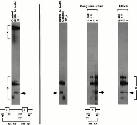 Fig. 3. Detection of germline p53 mutation in patient RUPN 84. SSCP analysis of genomic DNA from the t-AML and from cell line 2L1 showed identical band shift patterns with LOH in the region of p53 exon 8 (arrow, left). Schematic of strategy for PCR amplification andDra I restriction enzyme cleavage and resultant sizes of genomic DNA fragments containing p53 exon 7 and p53 exon 8 are shown below. SSCP analysis of p53 exon 8 in t-AML DNA and DNAs prepared from paraffin-embedded tissues showed the same band shift pattern in the ganglioneuroma, ERMS, and surrounding normal tissues, indicating that the p53 mutation was of germline origin (right). T, tumor tissue; N, normal tissue. There was LOH in the t-AML and the ERMS, but not in the ganglioneuroma. Sequencing of individual genomic subclones from t-AML DNA detected a CGA→TGA nonsense mutation at p53 codon 306 that created a premature termination codon and would foreshorten the predicted protein.