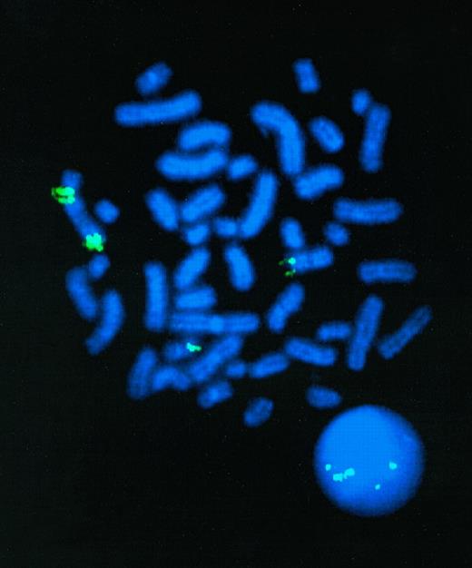 Fig. 1. FISH analysis demonstrating multiple copies ofMLL in t-AML of patient RUPN 84. Digoxygenin-labeledMLL YAC probe (Oncor) was hybridized to metaphase spread. Centromeric and telomeric signals are detected on der(11) chromosome (9 o'clock). Signals also are detected on der(5) chromosome (6 o'clock) and on normal chromosome 11 (3 o'clock). There are 5 discrete signals on nearby interphase nucleus. Five or 6 signals consistently were detected on hybridization of MLL YAC probe with other metaphase spreads from the t-AML.