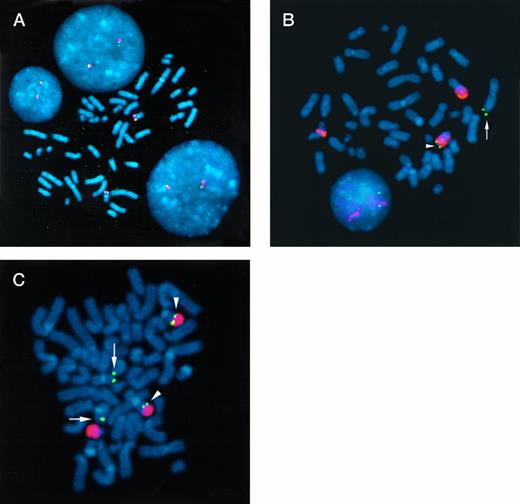 Fig. 4. Two-color FISH analysis of normal lymphocytes and 2 MM cell lines. (A) P1 clones containing the c-maf gene (red signal) and chromosome 16 sequences from the JJN3 MM t(14;16) breakpoint (green signal) were hybridized to metaphase chromosomes (counterstained blue) and interphase nuclei from normal lymphocytes. The signals colocalize at chromosome band 16q23. (B) A chromosome 14 painting probe (red signal) and a c-maf P1 clone (green signal) were hybridized to metaphase chromosomes from the OCI-My5 MM cell line. There are no normal copies of chromosome 14 or 16. One copy of c-maf (arrowhead) has been translocated to the telomeric end of chromosome 14 at band q32, consistent with a t(14;16)(q32;q23) translocation, involving the IgH locus and c-maf, respectively. A second copy of c-maf (arrow) is translocated to a structurally altered, unidentified chromosome. (C) A chromosome 22 painting probe (red signal) and a c-maf P1 clone (green signal) were hybridized to metaphase chromosomes from the 8226 MM cell line. There are 4 copies of the c-maf gene, 2 of which have chromosome 22 sequences translocated telomeric to c-maf (arrowhead), whereas 2 are on a normal chromosome 16 (arrow). The breakpoint on chromosome 22 is consistent with a t(16;22)(q23;q11) translocation near the c-maf and IgL, λ loci, respectively.