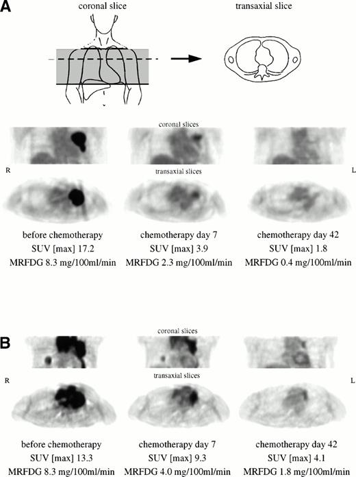 Fig. 1. (A) Bulky high-grade NHL in the left parahilar region with prominent FDG uptake. The patient (no. 5) showed CR over a follow-up period of 15 months. (B) Extensive mediastinal tumor mass of a high-grade NHL with an additional focal tumor lesion in the right lower lobe. The patient (no. 6) exhibited partial remission at day 42, but relapsed during the third course of chemotherapy. Myocardial FDG uptake at day 7 and day 42 does not reflect tumor involvement.
