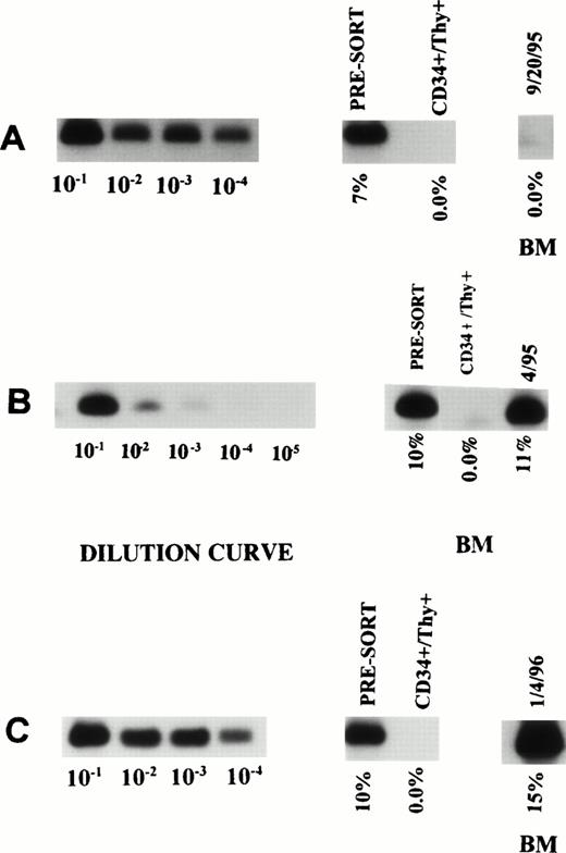 Fig. 1. ASO-PCR on PBSC harvest, purified CD34+Thy1+ Lin− cells and posttransplant BM in three patients (A, B, and C). The first 4 or 5 lanes represent the dilution curves for each patient. The subsequent lanes represent DNA from unsorted as well as purified CD34+ Thy1+ Lin−cells. The last lane shows the degree of tumor contamination in the posttransplant BM.