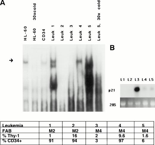 Fig. 6. Altered p21-promoter binding in a subset of leukemia cell extracts. (A) Protein extracts were prepared from five random frozen samples of leukemic blasts from peripheral blood of patients presenting acutely with AML, and binding to the p21-promoter was determined on gel shift. Differences in the presence and in the mobility of binding complexes are evident. The slowly migrating band in extract from patient no. 5 is specific and competed by cold fragment. A short exposure is shown. HL-60 and CD34 extracts are loaded for comparison. Equal amounts of protein are used in each binding reaction. FAB and FACS analysis results of the samples are also shown. (B) Northern blot demonstrates variable expression of p21 message in the leukemic samples.