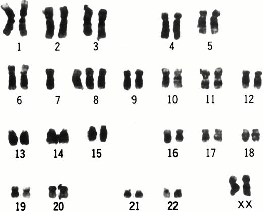 Fig. 3. Karyotype of UG3 cells. The consensus karyotype of UG3 cells was 46XX, −7, +8, t(9;11)(p22;q23). Chromosome analysis was performed twice.