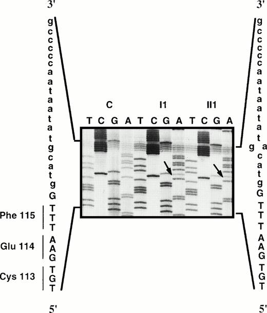 Fig. 1. Direct sequencing of the ivs e, +5 g→a mutation in the members of family J compared with a control (C).
