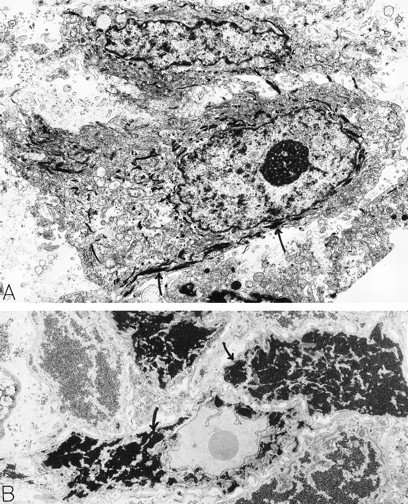 Squamous cell carcinoma. An 80-year-old man had a scalp lesion excised, which had been evident for three months. By light microscopy, this was a squamous cell carcinoma with an extensive clear cell component. Electron microscopy revealed typical squamous epithelial carcinoma cells attached by desmosomes and filled with bundles of electron-dense tonofilaments (arrows, A) in the cytoplasm. The clear cell component was comprised of glycogen-rich (B, arrows) squamous epithelial cells. The material for electron microscopy in (A) was processed by a standard method; in (B), the sample was postfixed in potassium ferrocyanide-reduced osmium to highlight glycogen stores which are electron dense (B, arrows). A: ×8,000; B: ×6,000. Original magnifications: (A), ×8,000; (B), ×6,000. (Courtesy of Ann M. Dvorak, MD, Beth Israel Deaconess Medical Center, 330 Brookline Ave, Boston, MA 02215.)
