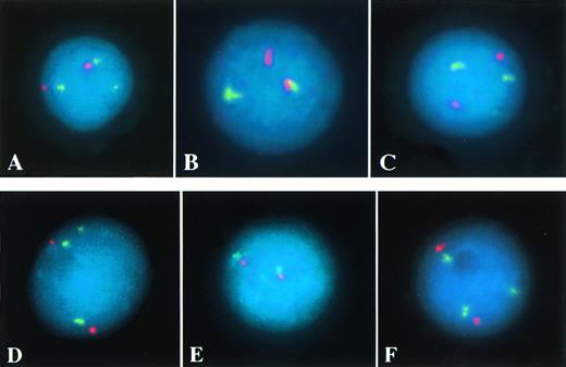 Fig. 1. (A through C) Interphase FISH of patient no. 1 (AML withAF10 and CALM rearrangement, Table 1). Three AF10 signals (green), indicating a split of one YAC signal, and two centromere 10 signals (red) are detectable in (A). In (B), the proximal (green) and the distal CALM YAC (red) are separated, indicating a breakpoint within this genomic region. Two MLL signals (green) and two centromere 11 signals (red) suggest no rearrangement of the MLL region in (C). (D through F) Interphase FISH of patient no. 8 (AML with AF10 and MLL rearrangement). Three AF-10 signals (green), indicating a split of one YAC signal, and two centromere 10 signals (red) are detectable in (D). In (E), the proximal (green) and the distal CALM YAC (red) are colocalized, excluding a rearrangement of this genomic region. In (F), the detection of three MLL signals (green), but only two centromere 11 signals (red) indicate a split of one MLL probe (C).