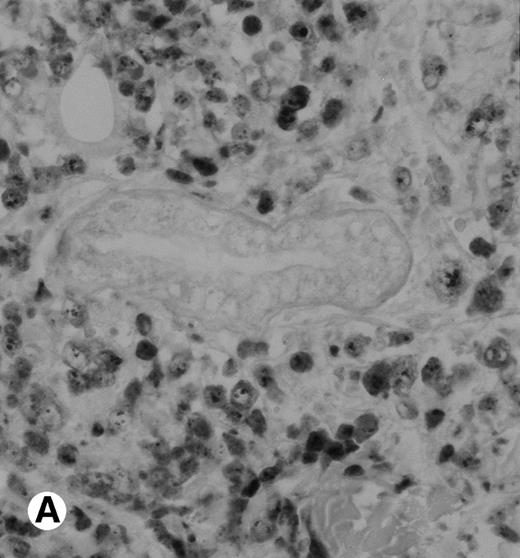 Fig. 3. Immunohistochemical detection of chimeric NPM-ALK protein (×400). A case of CD30+ primary CLCL (case no. 8; A) and a case of CD30+ secondary CLCL (case no. 1; B) both with a positive NPM-ALK amplification by both RT-PCR and DNA-PCR were stained with the monoclonal ALK1 antibody. A granular cytoplasmic and strong nucleolar staining was observed on the large lymphomatous cells in these 2 cases.