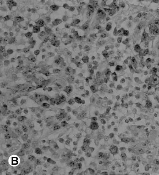 Fig. 3. Immunohistochemical detection of chimeric NPM-ALK protein (×400). A case of CD30+ primary CLCL (case no. 8; A) and a case of CD30+ secondary CLCL (case no. 1; B) both with a positive NPM-ALK amplification by both RT-PCR and DNA-PCR were stained with the monoclonal ALK1 antibody. A granular cytoplasmic and strong nucleolar staining was observed on the large lymphomatous cells in these 2 cases.