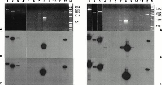 Fig. 4. Amplification of genomic breakpoint on derivative chromosome 5. Genomic DNA was subjected to standard and nested amplification, followed by product separation on a 1% agarose gel. Ethidium bromide staining of standard DNA-PCR products (A) and of nested DNA-PCR products (D). Lanes 1 through 11, cases no. 1 through 11; lane 12, t(2;5)+ SU-DHL-1 cell line; lane M, molecular weight marker 1-kb DNA ladder (GIBCO-BRL). The gels were transferred to a nylon membrane and hybridized either with the ALK-5P (radioautographies B and E) or the NPM-5P (radioautographies C and F). The sizes are indicated in bases.