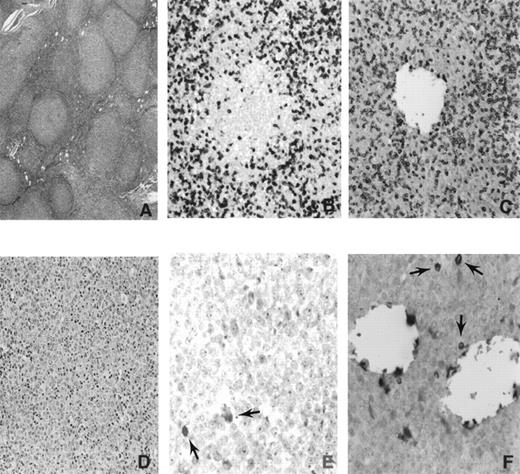 Fig. 1. Representative photomicrographs of a microdissected low-grade and progressed FCL. (A) LGFCL (hematoxylin and eosin). (B) LGFCL before microdissection (CD3 immunostain ). (C) LGFCL after microdissection (CD3 immunostain). (D) Diffuse large-cell lymphoma (hematoxylin and eosin). (E) Diffuse large-cell lymphoma before microdissection (CD3 immunostain). (F) Diffuse large-cell lymphoma after microdissection (CD3 immunostain). Arrows indicate CD3 positive cells in E and F.