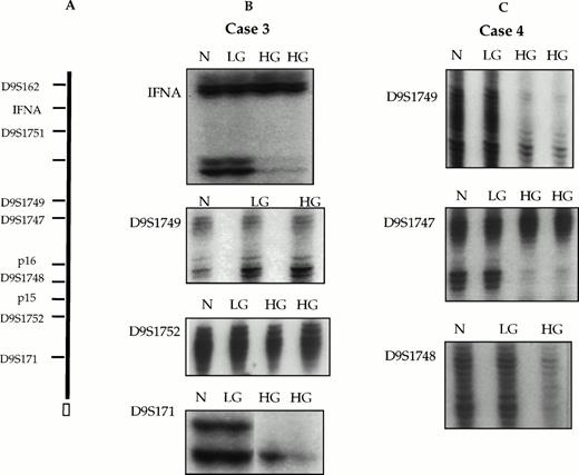 Fig. 3. LOH analysis of normal (N), low-grade (LG), and progressed DLCL (HG) samples microdissected from 2 selected cases (cases no. 3 and 4). (A) Map location of polymorphic markers on chromosome 9p21. (B) Case no. 3 showing apparent retention of heterozygosity in the progressed DLCL samples (HG), indicating homozygous deletions at D9S1749 and D9S1752 flanked by LOH, indicated by loss of the lower allele at IFNA, and the upper allele at D9S171. (C) Case no. 4 showing LOH in the DLCL samples (HG), encompassing 3 markers, indicated by loss of the upper allele at D9S1749 and loss of the lower alleles at D9S1747 and D9S1748.