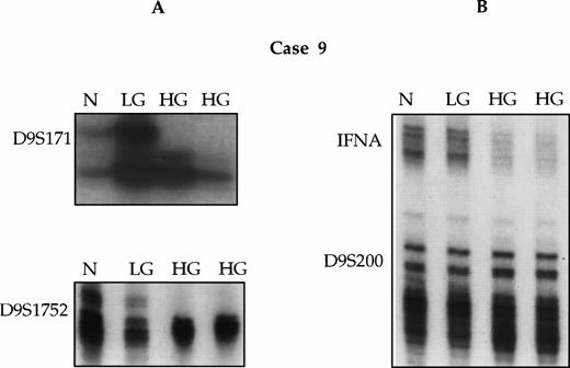 Fig. 4. LOH analysis and comparative multiplex PCR of normal (N), low-grade (LG), and progressed DLCL (HG) components of a selected case (case no. 9). (A) Case no. 9 showing loss of upper alleles at D9S171 and D9S1752 in the DLCL (HG) lanes. (B) Comparative multiplex PCR showing marked diminution in the intensity of the IFNA alleles in the DLCL lanes (HG) in comparison to the normal (N) and the LGFCL (LG) lanes. In addition, the signal intensity of the IFNA alleles is lower in both (HG) lanes in comparison to the D9S200 alleles.