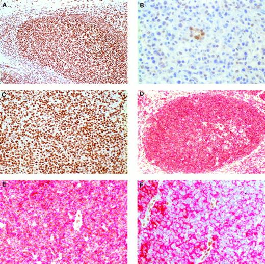 Fig. 5. p16 immunohistochemistry in LGFCL, progressed DLCL, and de novo DLCL. (A) LGFCL (case no. 7) showing strong nuclear reactivity (brown nuclear staining) in the majority of the neoplastic follicular center cells (original magnification × 100). (B) Progressed DLCL showing lack of p16 expression in the neoplastic cells (case no. 7). Note the positive (brown) staining in the (internal control) renal tubular epithelial cells (original magnification × 400). (C) De novo DLCL showing diffuse positive staining for p16 in majority of the tumor cells (original magnification × 200). Double immunostaining for p16 and CD20. (D) LGFCL (case no. 5) showing dual reactivity for p16 (brown nuclear stain) as well as strong membrane reactivity for CD20 (red) (original magnification × 100). (E) Higher magnification of (D) (original magnification × 200). (F) Progressed DLCL (case no. 5) showing the absence of p16 expression in the nuclei of the neoplastic CD20+ cells. Note the strong p16 expression in the (internal control) endothelial cells (original magnification × 400).