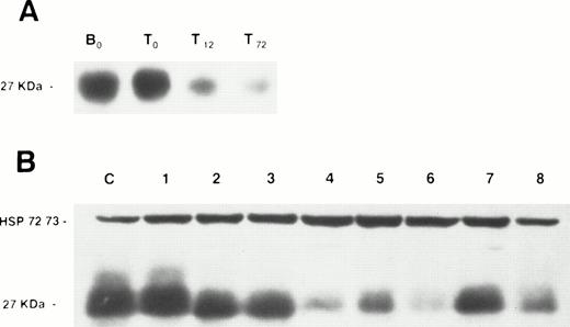 Fig. 1. Western blot analysis of p27 protein expression in normal lymphocytes and lymphoproliferative disorders. (A) A membrane containing protein extracts from normal resting B lymphocytes (B0), normal resting T lymphocytes (T0), PMA + PHA-stimulated T lymphocytes after 12 (T12) and 72 (T72) hours of culture. (B) A membrane containing protein extracts from peripheral blood lymphocytes of the B-CLL patient serving as positive control (C), and peripheral blood lymphocytes of five B-CLL patients (no. 1 through 5), a patient with MCL (no. 6), and two LPL patients (no. 7 and 8). Each lane was loaded with 100 μg of total protein. Blots were exposed to anti-p27 antibody and anti-HSP 72/73 as protein deposit control.