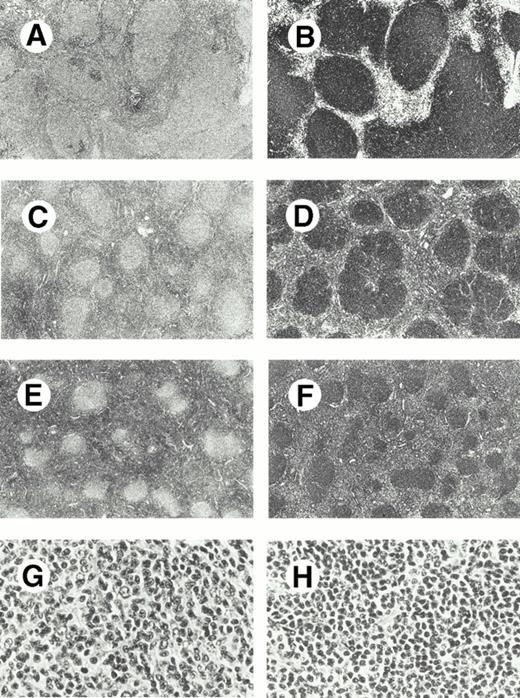Fig. 1. Interfollicular neoplastic B cells in follicular lymphoma. (A-F) Three cases of follicular lymphoma with minimal (case 8; A, B), moderate (case 13; C, D), or prominent (case 2; E, F) CD20+ interfollicular neoplastic B-cell component. (G, H) High-power view of follicular (G) and interfollicular (H) components showing lower-grade cytology of interfollicular cells in case 13. (A, C, E, G, and H, H&E; B, D, and F, immunoperoxidase)